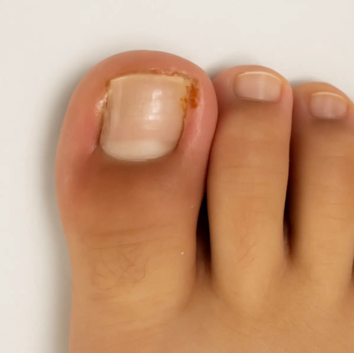 Pediatric ingrown toenail treatment photo at Pediatric Foot and Ankle Chandler AZ