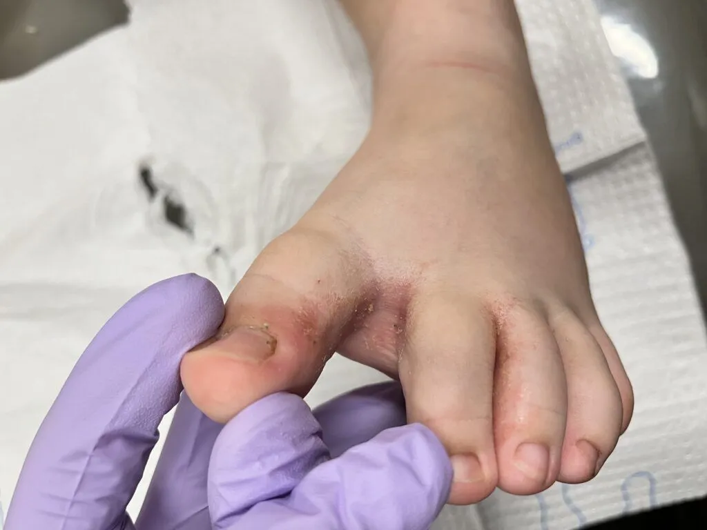 athletes foot toe image