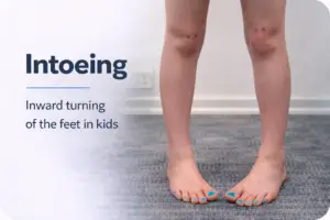 Child standing barefoot with both feet turned inward, showing intoeing (pigeon-toed walking) in kids
