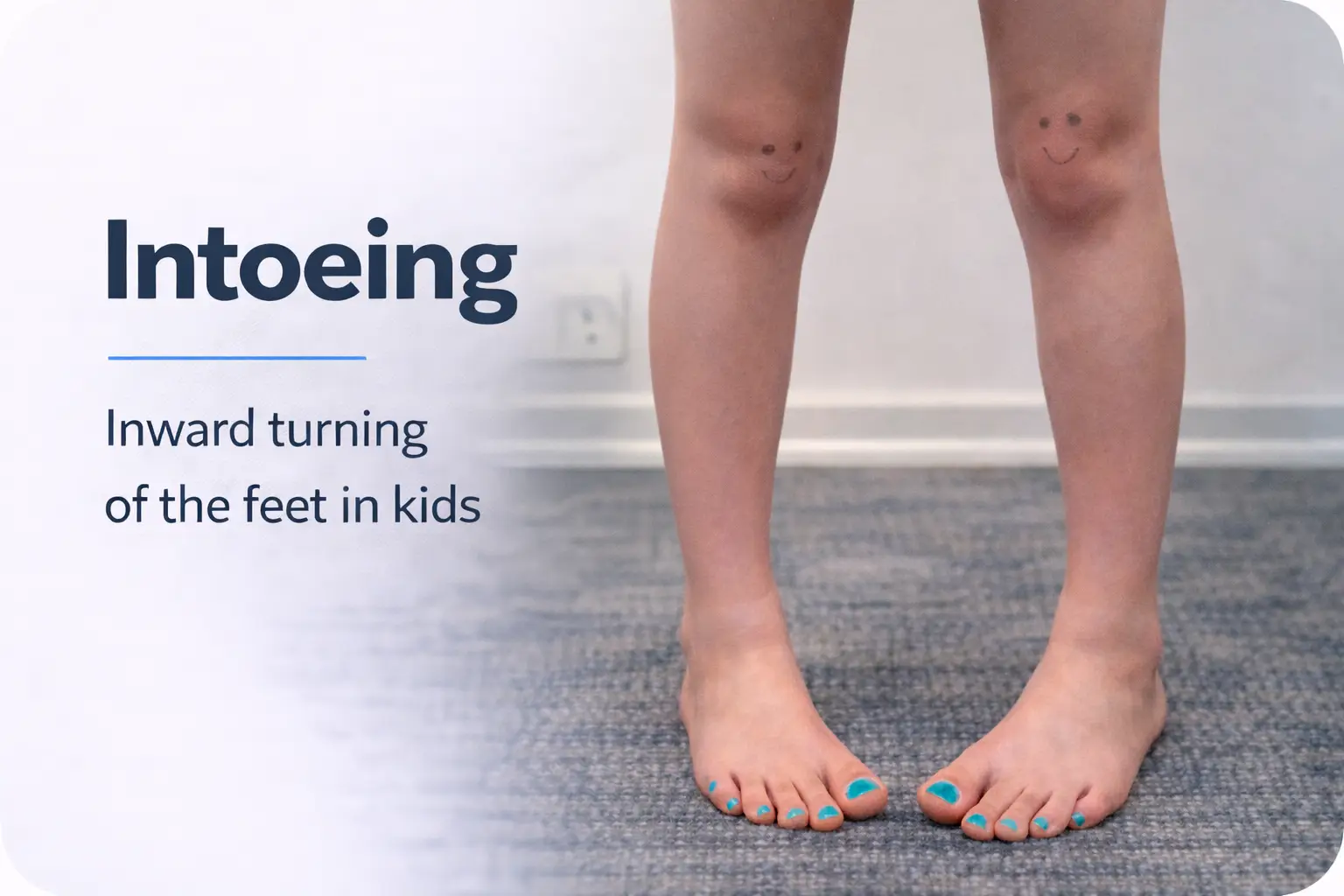 Child standing barefoot with both feet turned inward, showing intoeing (pigeon-toed walking) in kids