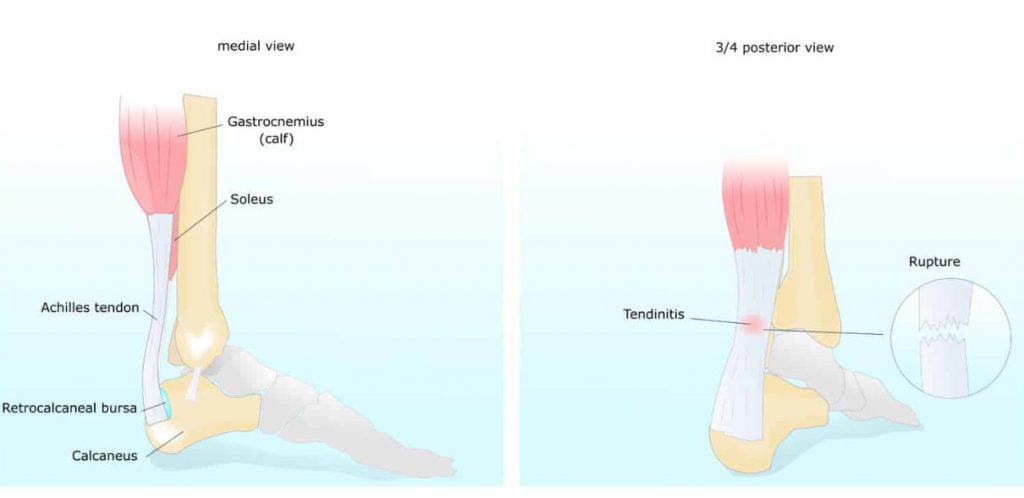 Achilles tendon pain on sale walking