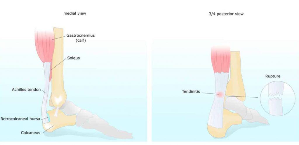 Achilles tendon and calf muscle illustration