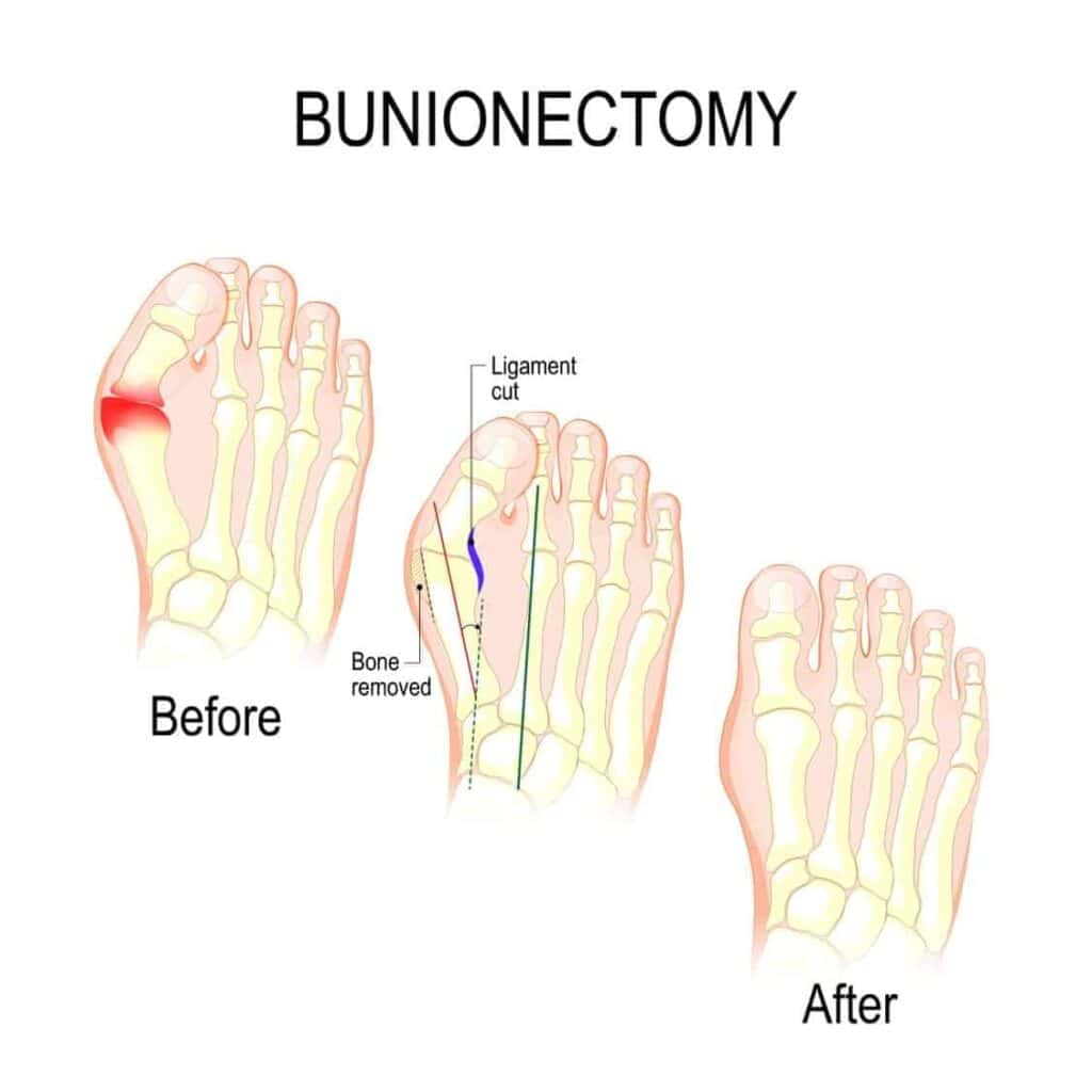 Pediatric Bunion Surgery Pediatric Foot & Ankle Treatments