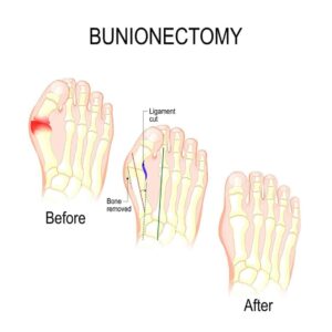 Pediatric Bunion Surgery - Pediatric Foot & Ankle