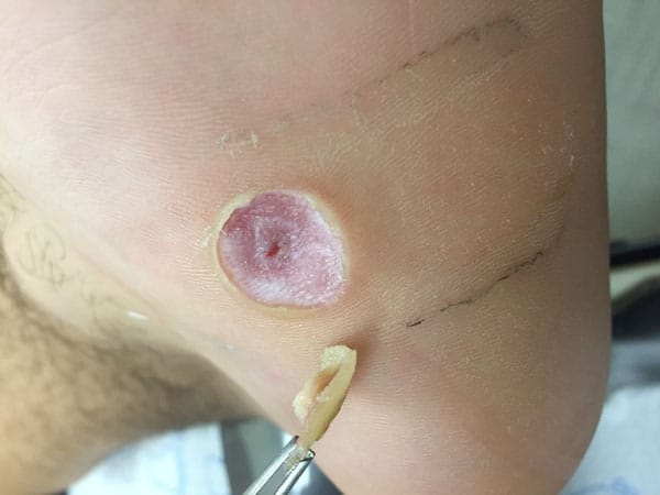 Plantar Wart Removal and Treatment Dr. Mikkel Jarman Podiatrist Phoenix
