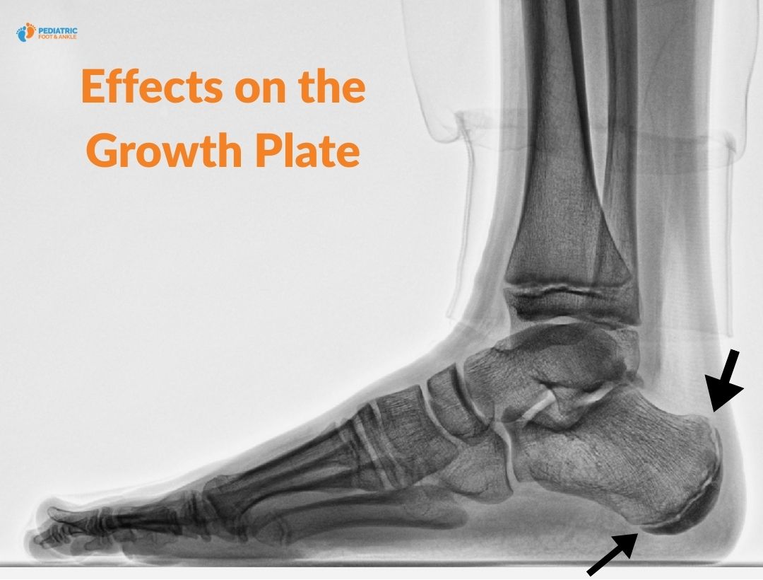 xray image of a left foot The arrows in the X-ray point to the calcaneal apophysis (the growth plate at the back of the heel). In Sever’s disease, this area becomes inflamed and irritated due to repetitive stress from the Achilles tendon pulling on the bone