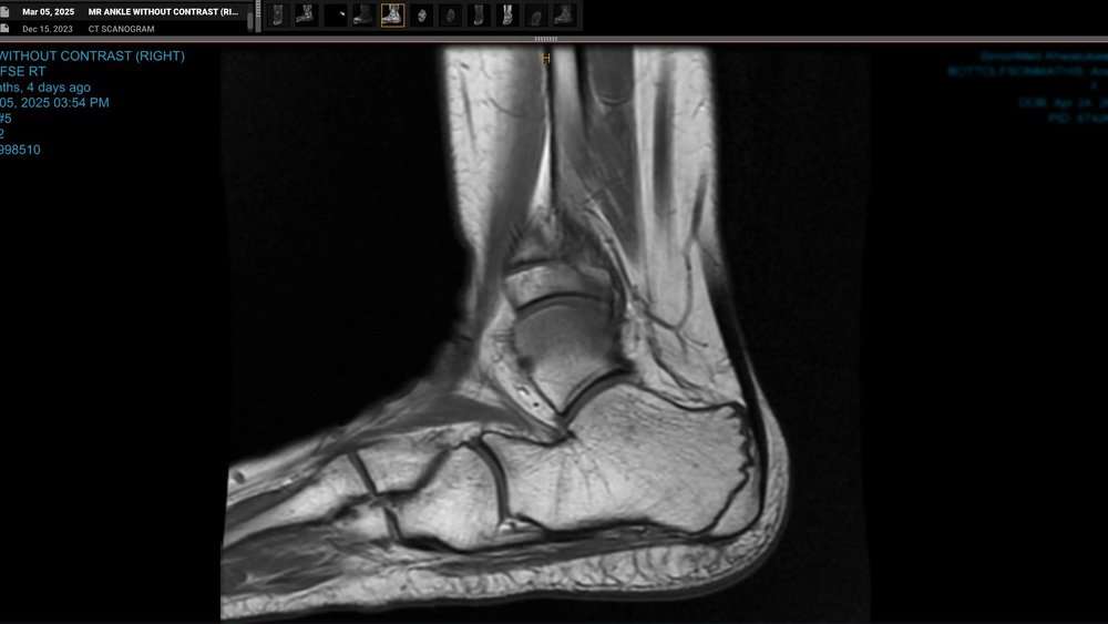 Tarsal-Tunnel-Syndrome-in-Children-2-1