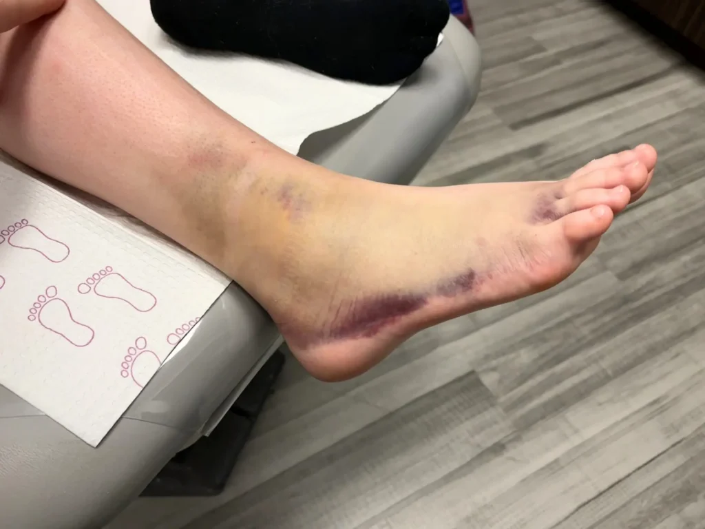 Ankle Fracture image of bruised foot in office