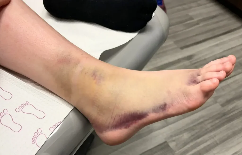 Ankle Fracture image of bruised foot in office