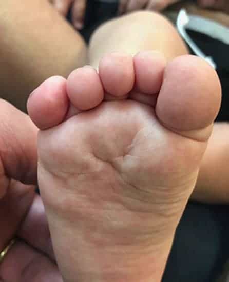 Bottom view of child's foot with polydactyly "merged"