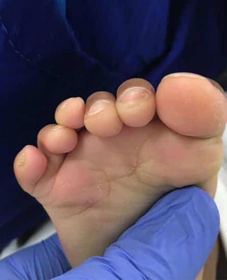 Bottom view of a child's foot with polydactyly "non-merged"