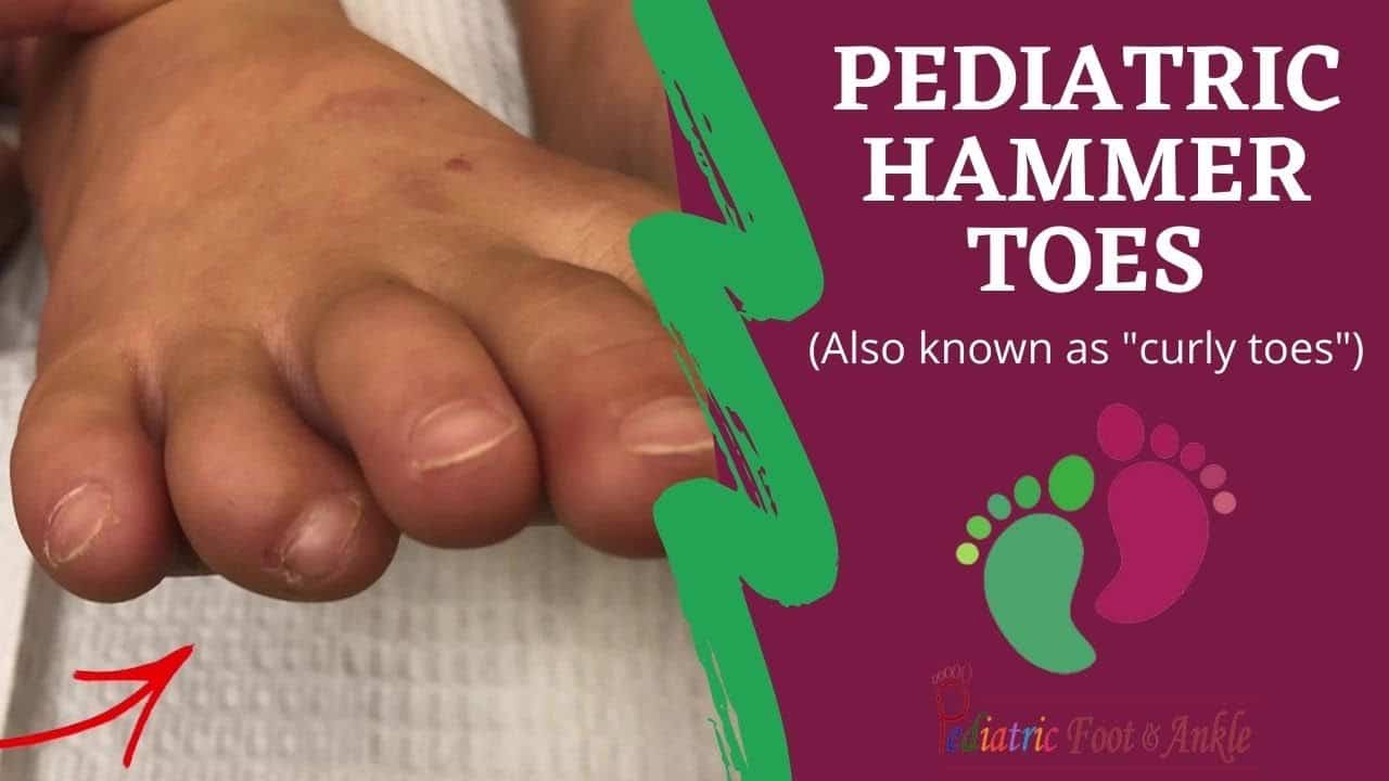 HAMMER TOES – sparshdiabeticfootandwoundcareclinic