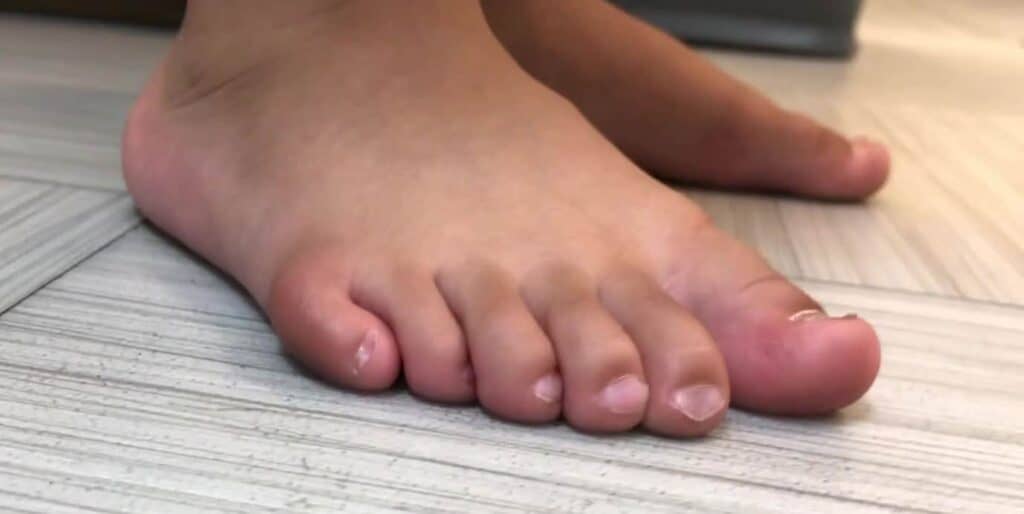 Polydactyly extra toe on foot pre-surgical