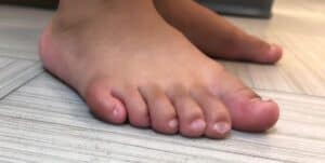 Polydactyly - Pediatric Foot & Ankle