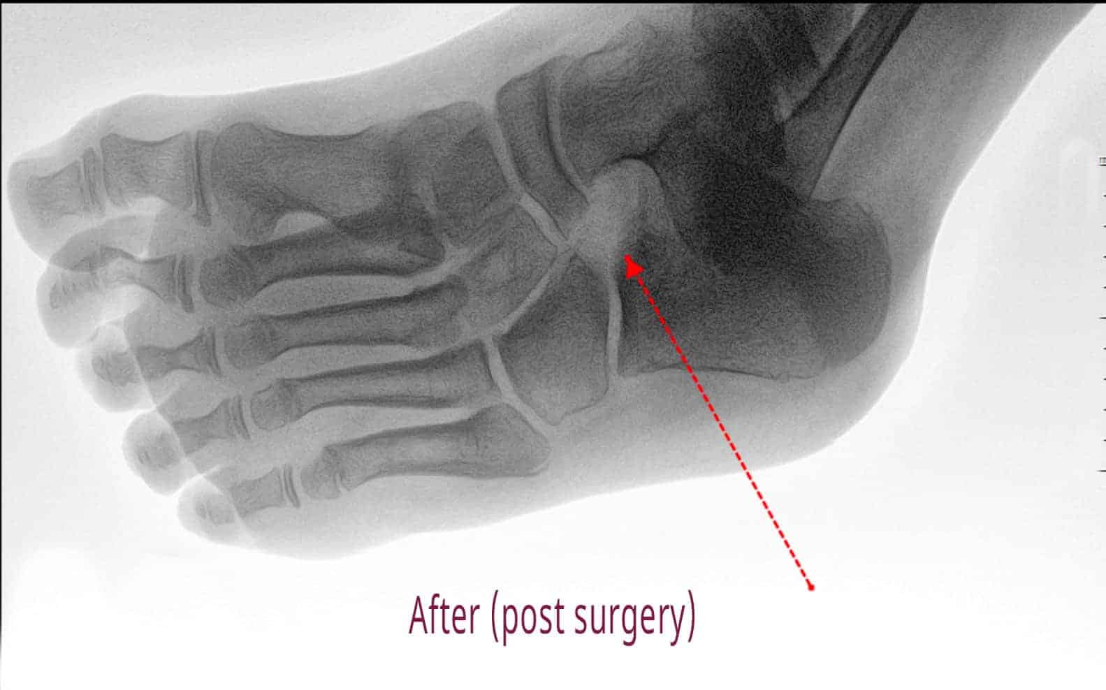 tarsal-coalitions-xrays-after.jpg