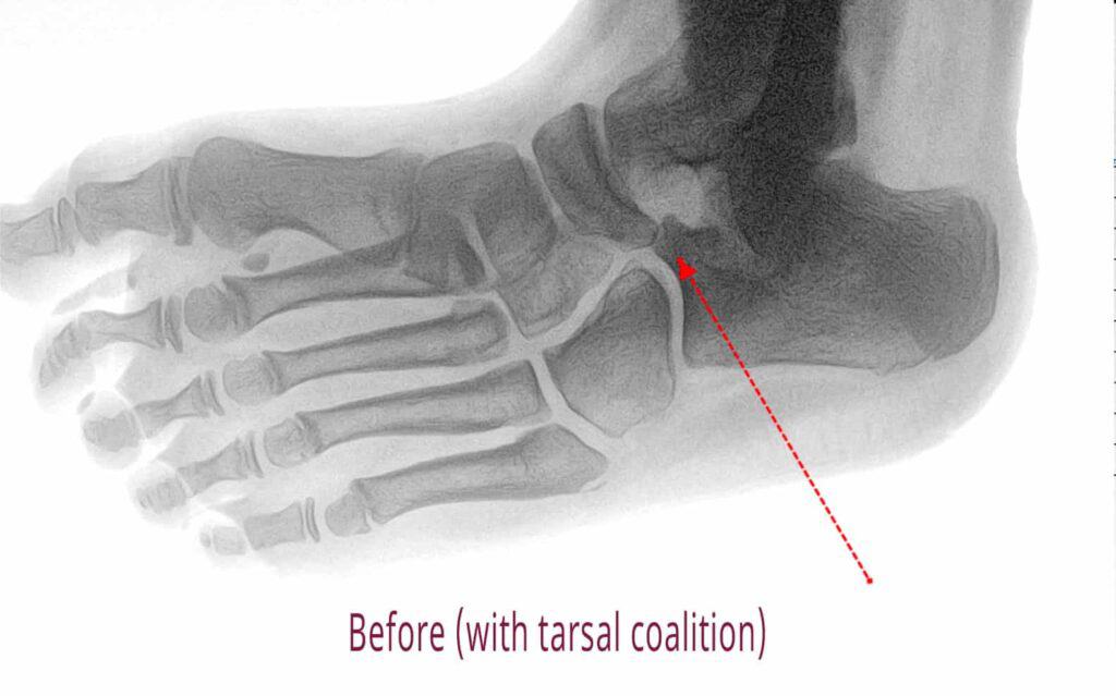 xray of a tarsal coalition before surgery